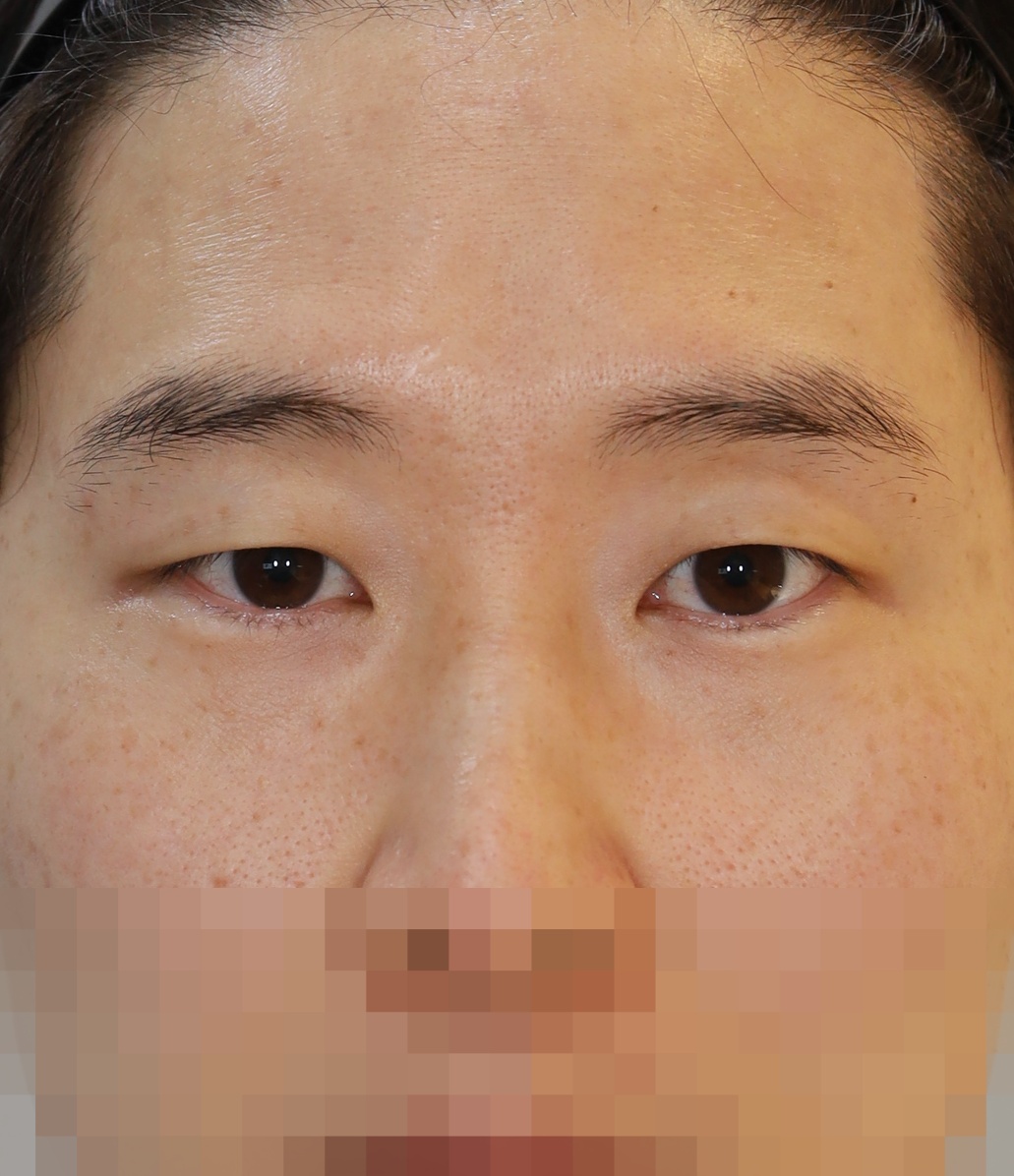 비절개 쌍꺼풀 3개월 수술전