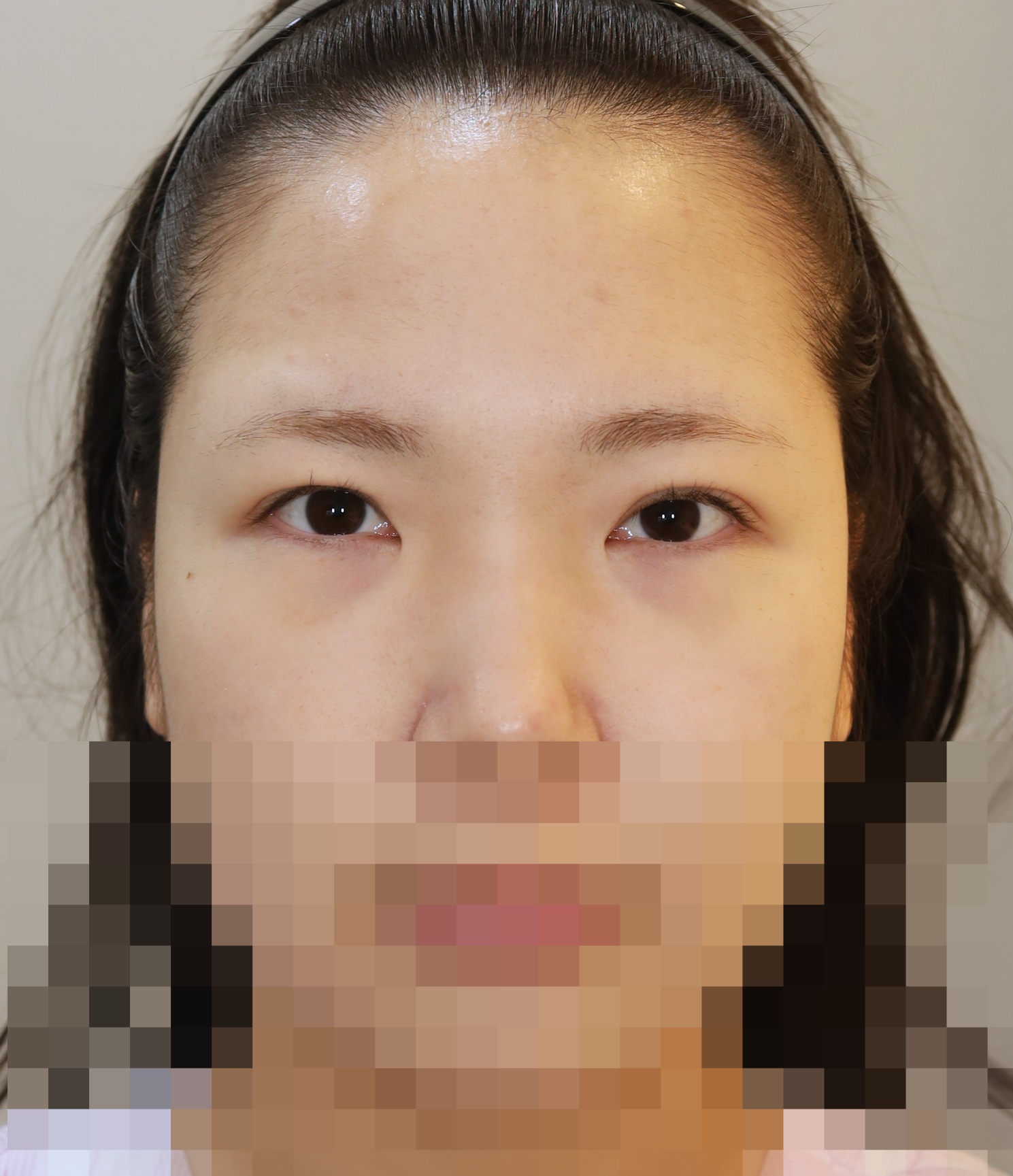 쌍꺼풀 라인 낮추기; 두줄따기 수술전