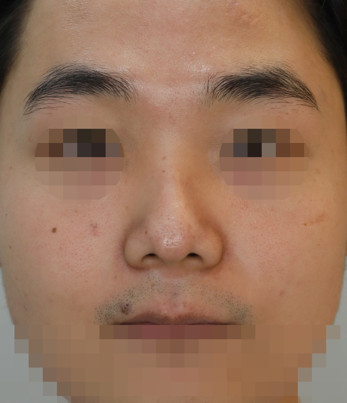 콧대(일반보형물), 코끝(귀연골), 콧날개연골재건, 비주내리기 4개월 수술전