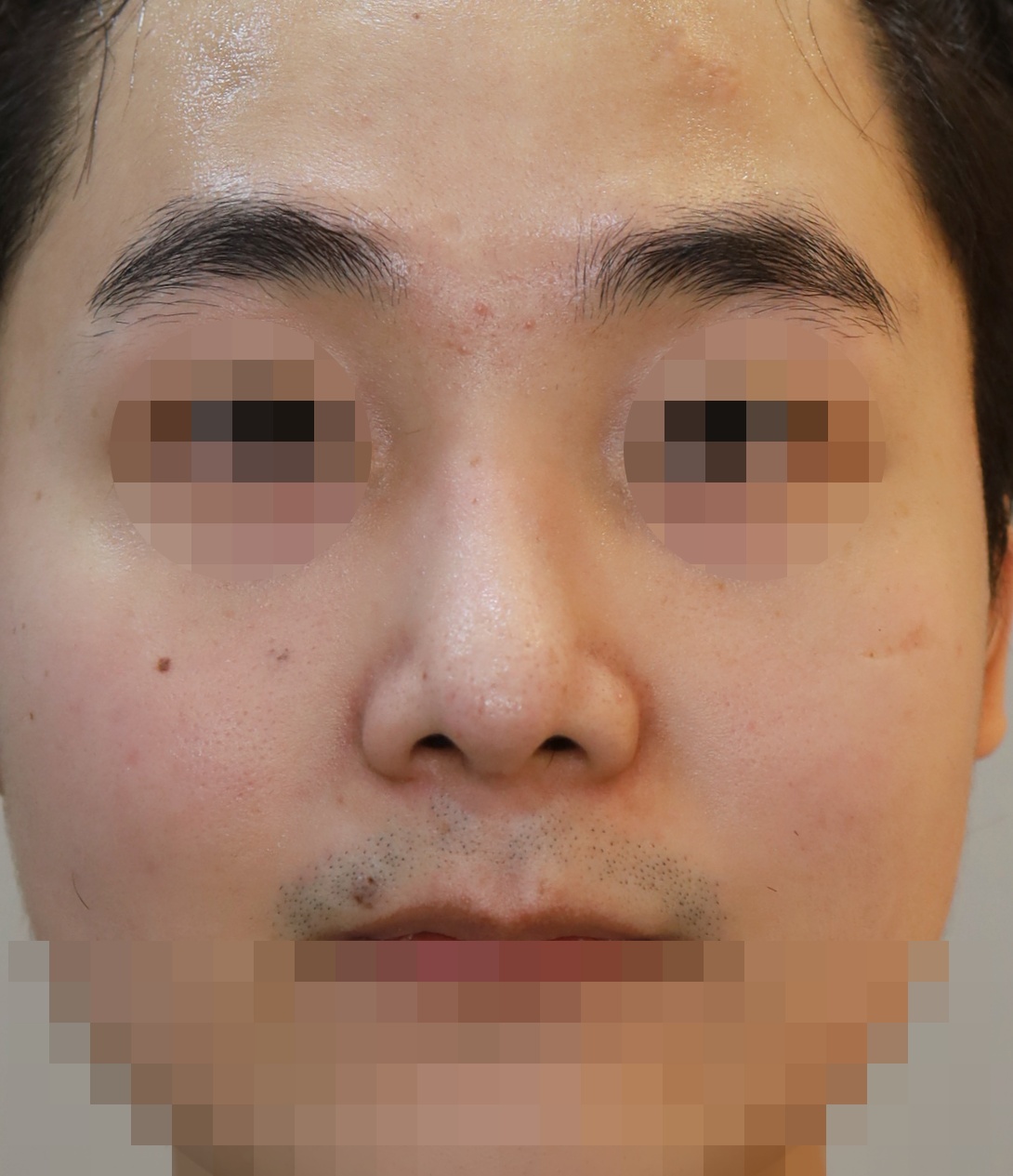 콧대(일반보형물), 코끝(귀연골), 콧날개연골재건, 비주내리기 4개월 수술후
