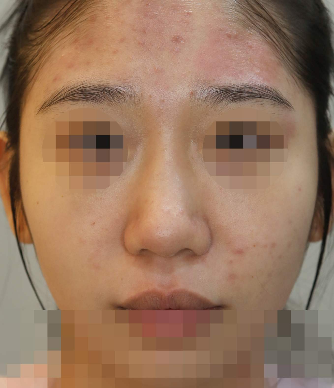 무보형물 코성형; 복코 교정 수술전