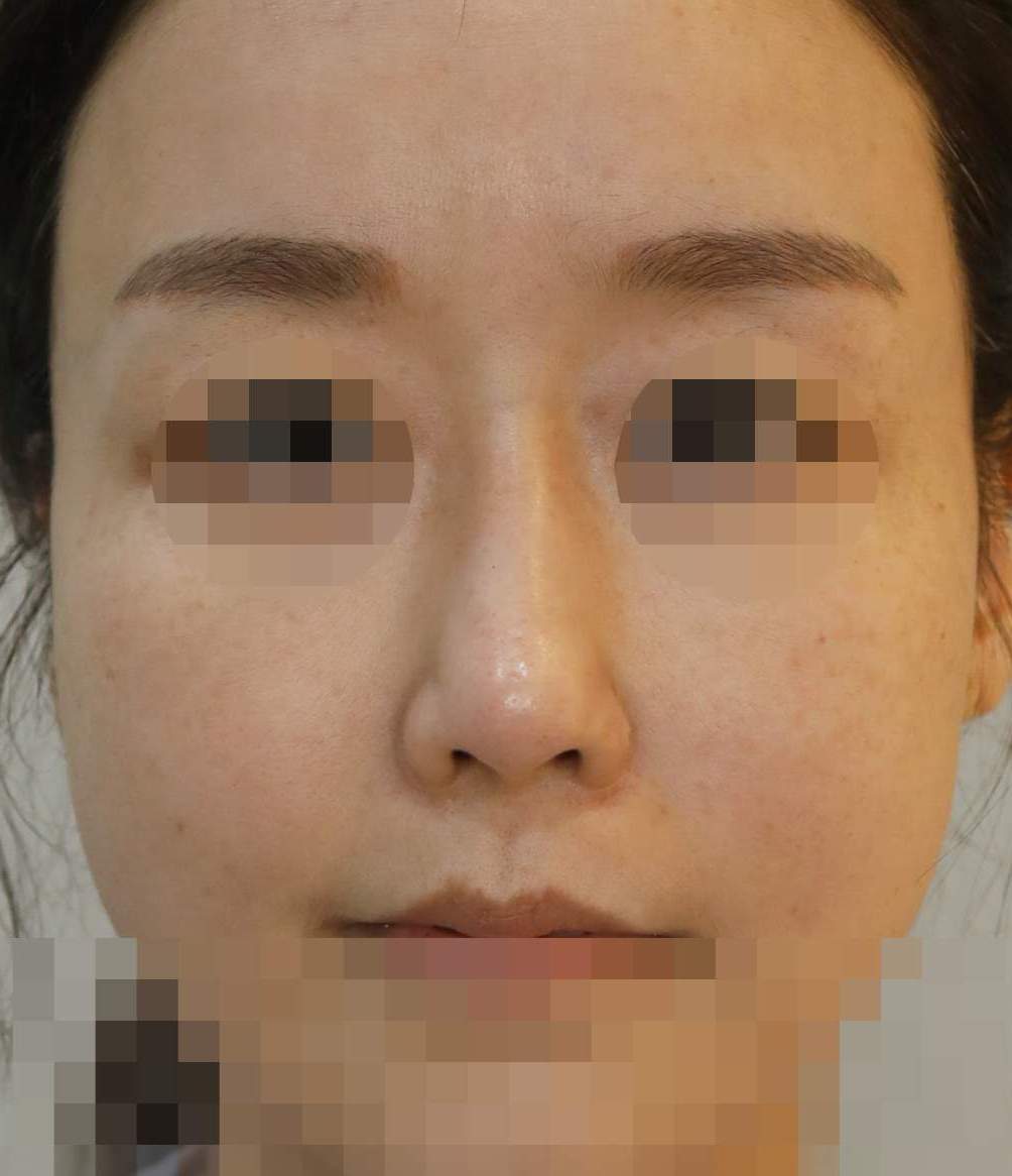 보형물 제거, 휜코 교정, 찝힌코 교정(콧볼 재배치) 수술전