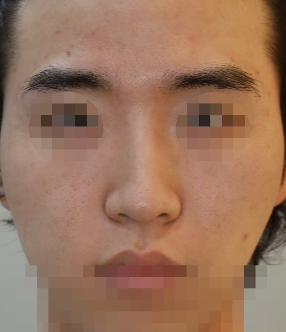 무보형물 코성형; 휜코 교정, 매부리 교정 수술전
