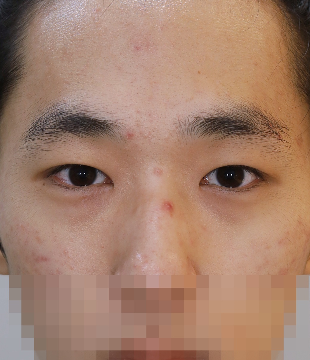 비절개 눈매교정, 위트임, 안검내반 교정 3개월 수술후