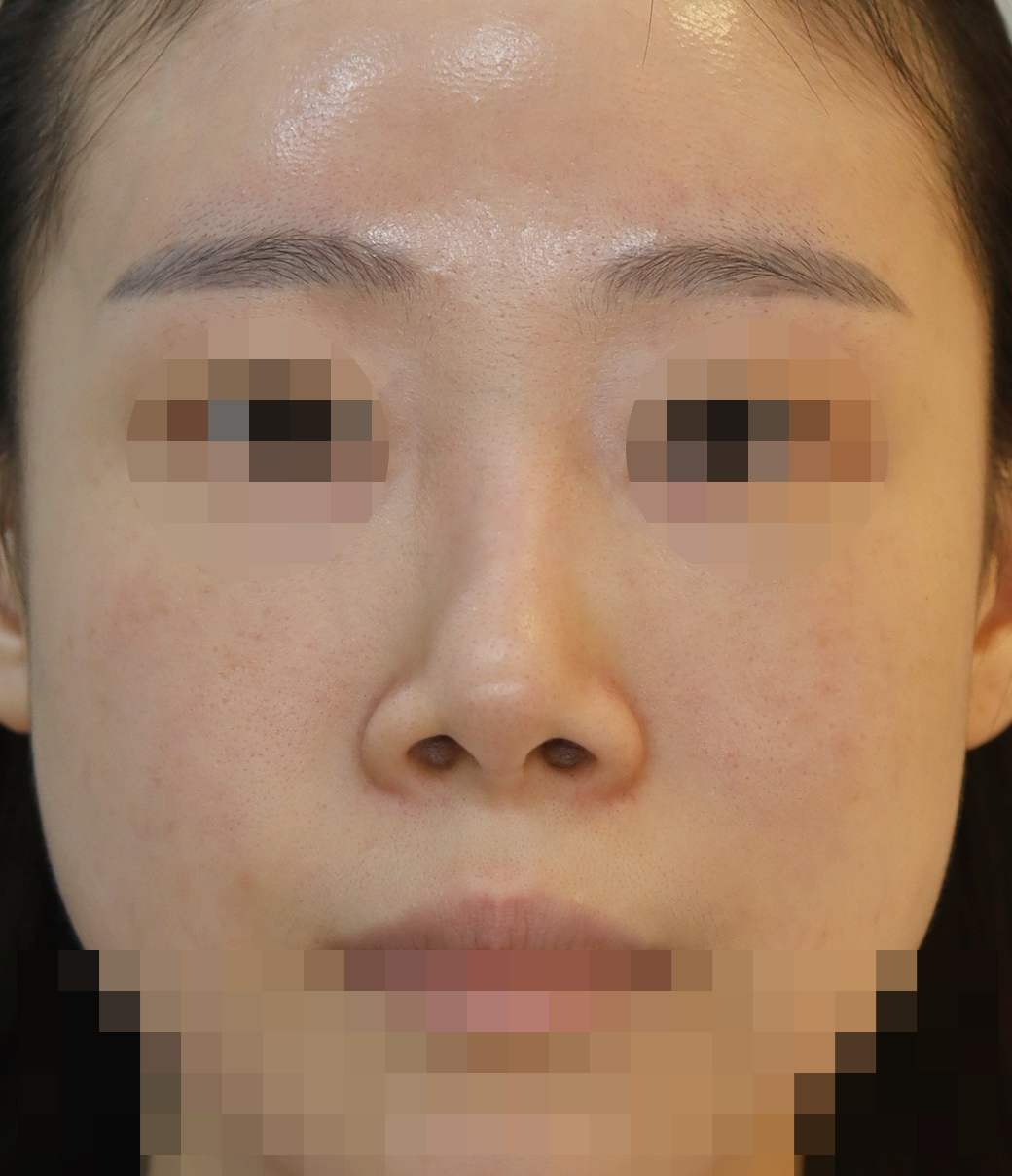 무보형물 코재수술; 들린코 교정 6개월 수술전