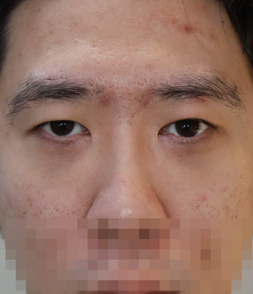 쌍꺼풀 라인 낮추기; 두줄따기 수술후