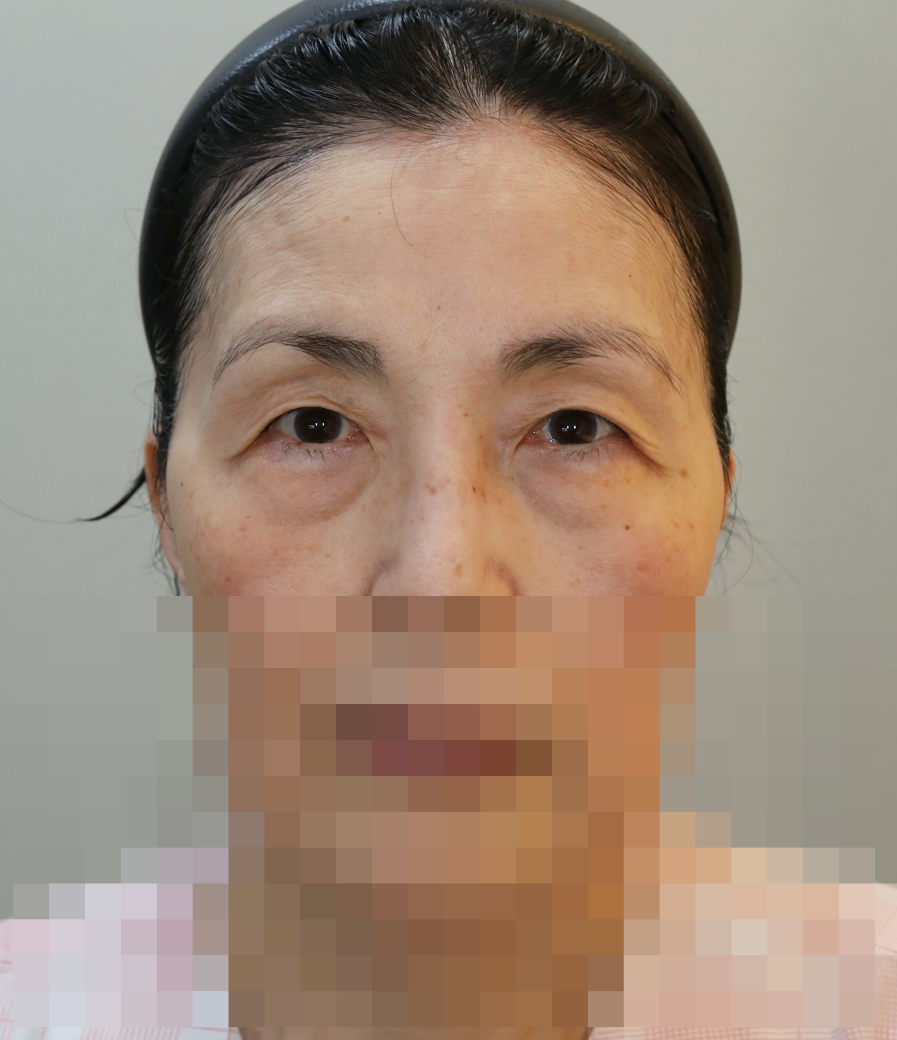 이마 거상, 눈썹하거상, 쌍꺼풀 재수술; 매몰, 눈밑 지방 재배치 5개월 수술전