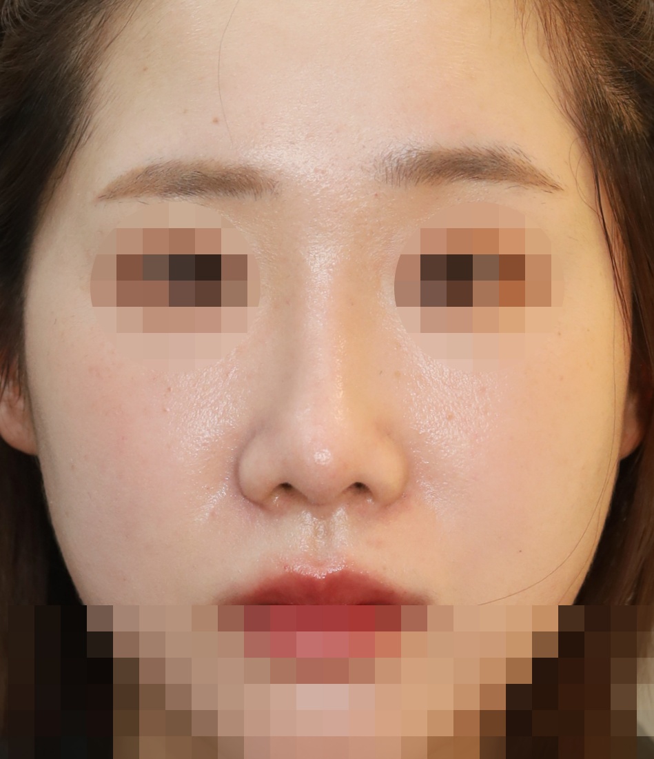 콧대(일반보형물), 코끝(비중격연골), 비순각 교정 수술후