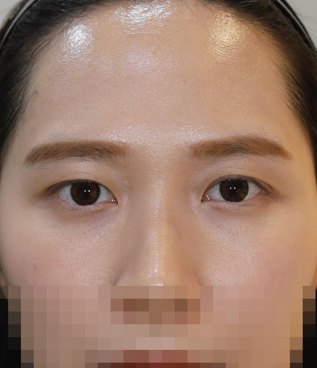 쌍꺼풀 라인 낮추기, 눈위 지방 재배치 1개월 수술후
