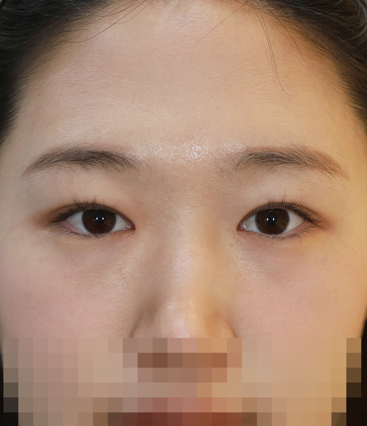 쌍꺼풀 라인 낮추기; 피부 절제법, 아래 안검내반 교정 3개월 수술후