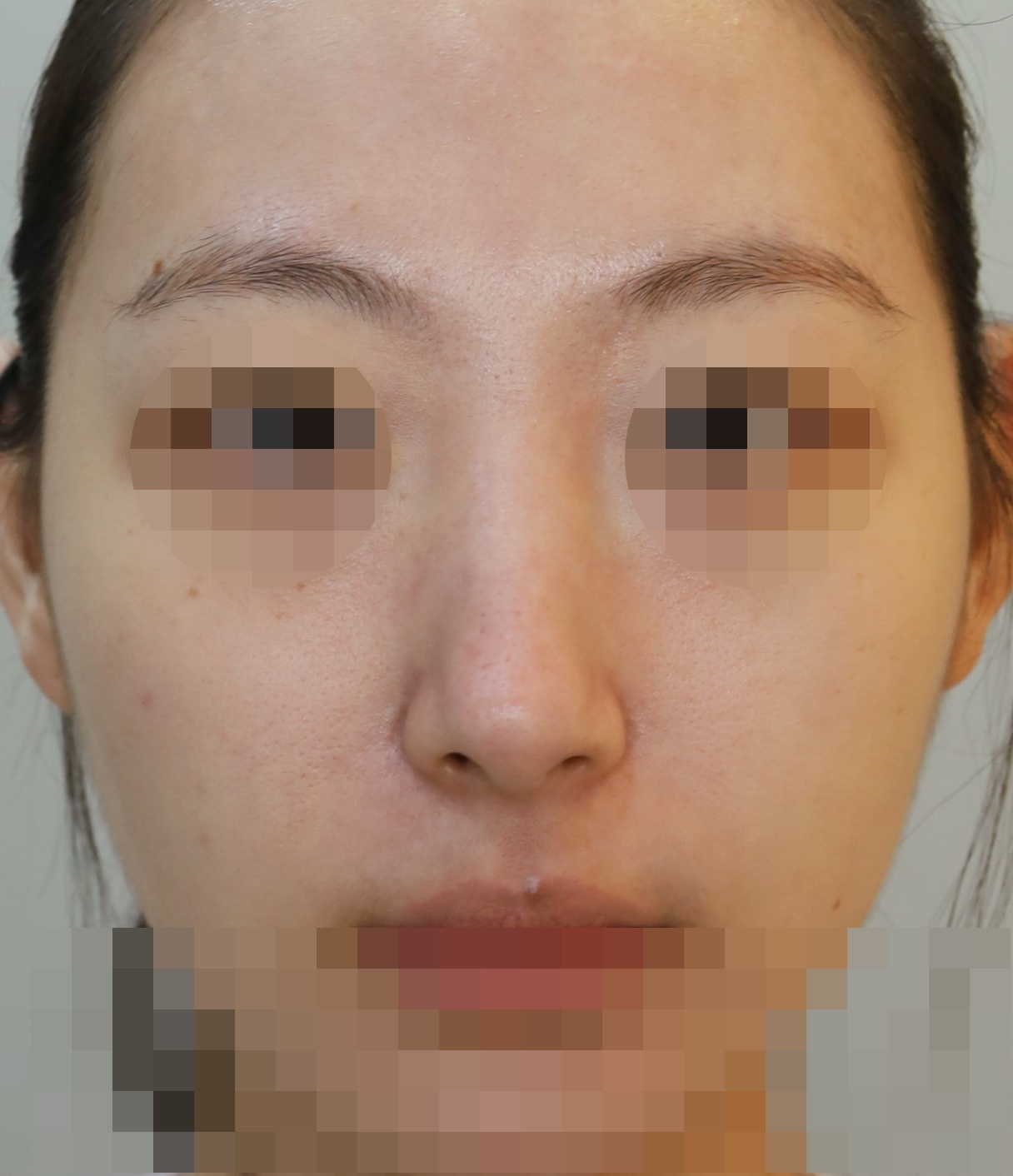 과교정 매부리 복원, 코끝 복원 3개월 수술전