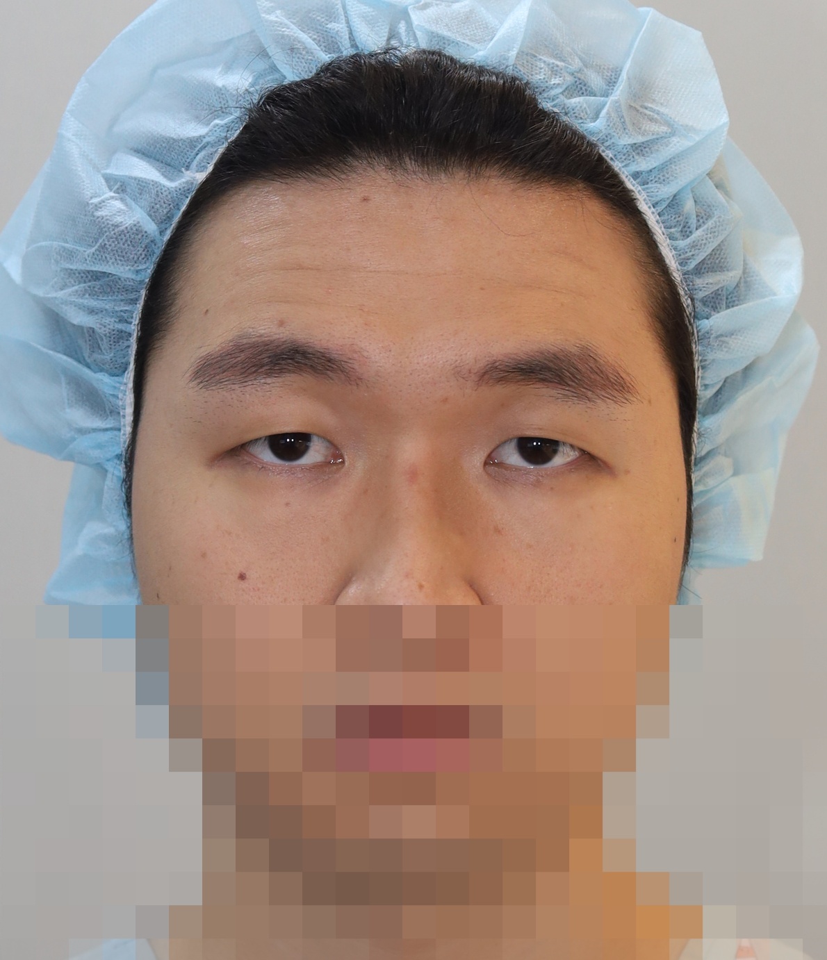 이마거상, 절개쌍꺼풀 3개월 수술전