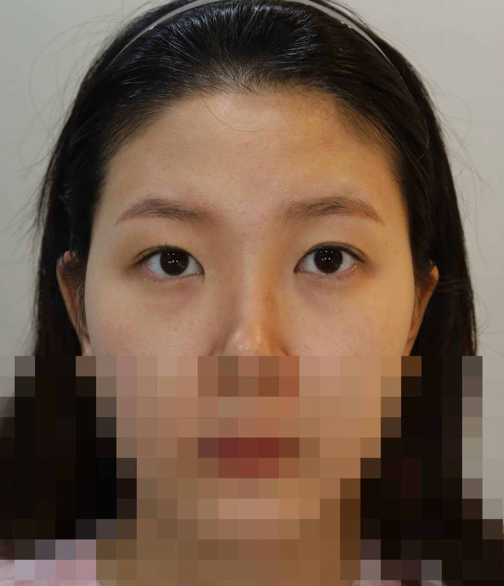 눈재수술(매몰, 앞위트임), 이마거상 1년 수술전