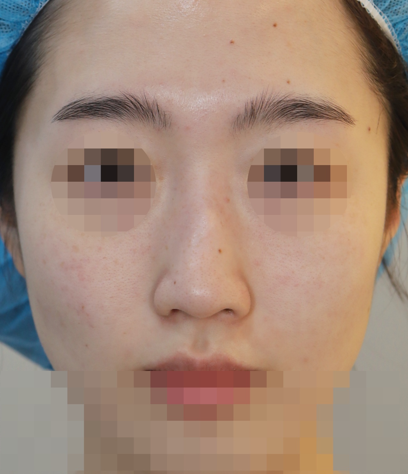 무보형물 코성형; 휜코 교정, 매부리 교정 3개월 수술전