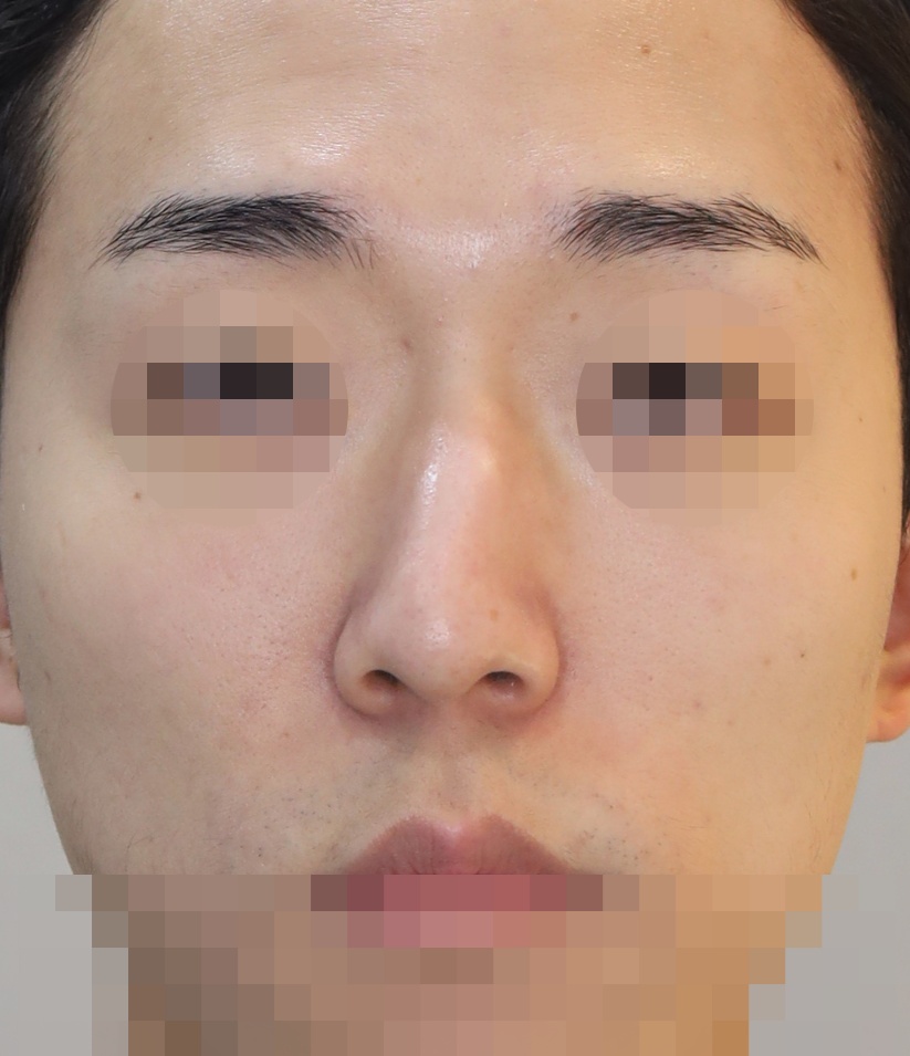 무보형물 코성형; 휜코 교정, 매부리 교정 11개월 수술전