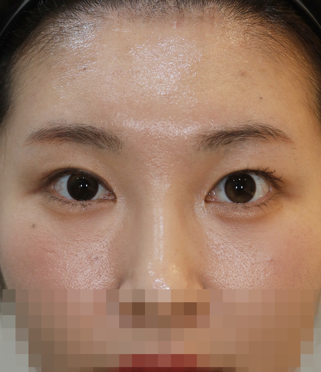 쌍꺼풀 라인 낮추기; 두줄따기 3개월 수술후