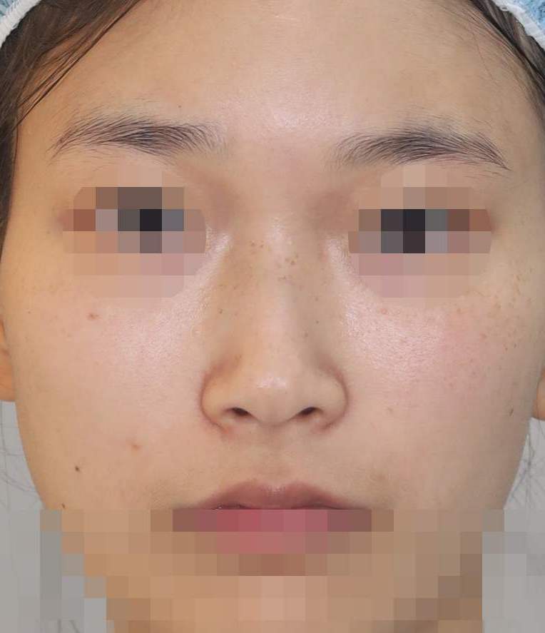 콧대(일반보형물), 코끝(귀연골), 비순각 교정 2년 수술전