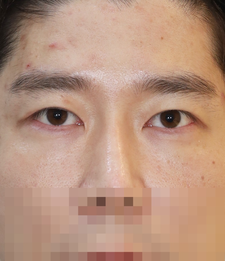 쌍꺼풀 라인 낮추기; 두줄따기 수술후