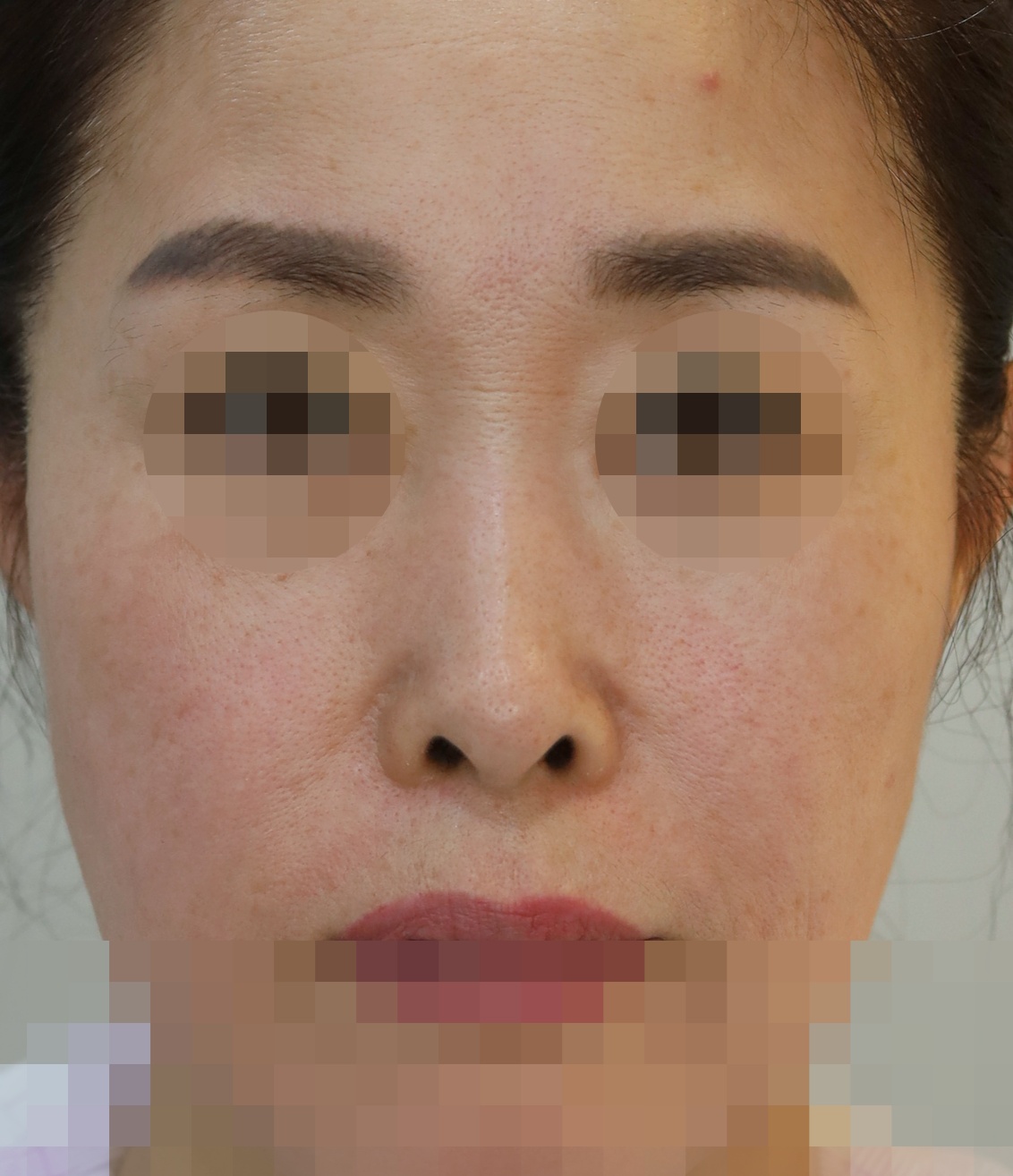 무보형물 코성형; 용코 교정, 비공내리기 수술전