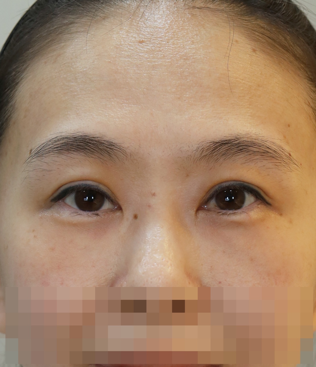 쌍꺼풀 라인 낮추기, 눈위 지방 재배치 수술전