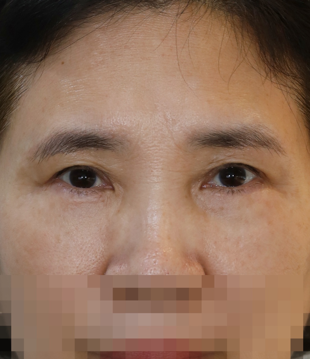 눈썹 밑 거상, 하안검 6개월 수술후