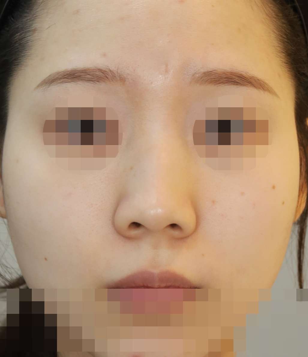 무보형물 코성형; 짧은코 교정 5개월 수술전