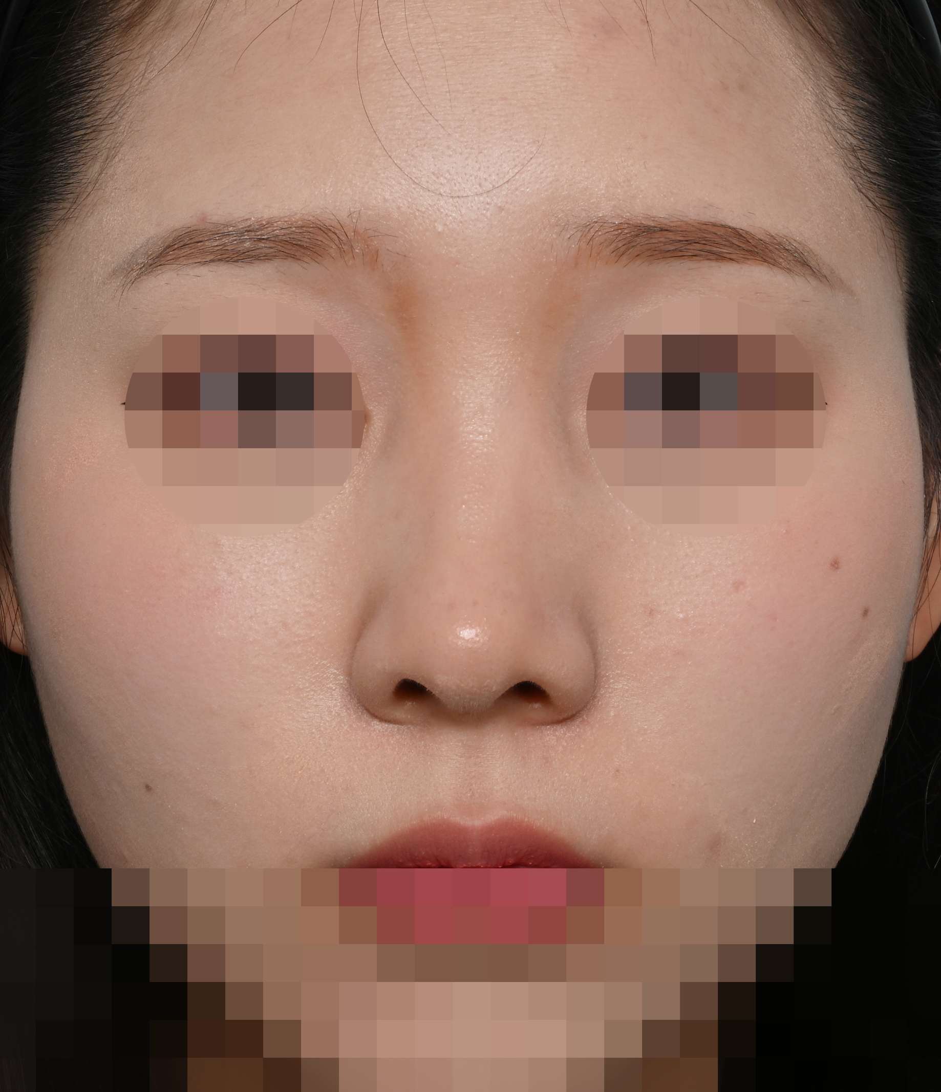 무보형물 코성형; 짧은코 교정 5개월 수술후