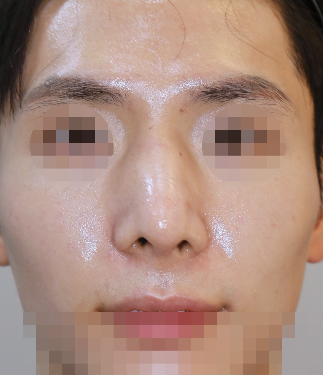 보형물 제거, 휜코 교정, 코끝 복원 3개월 수술후