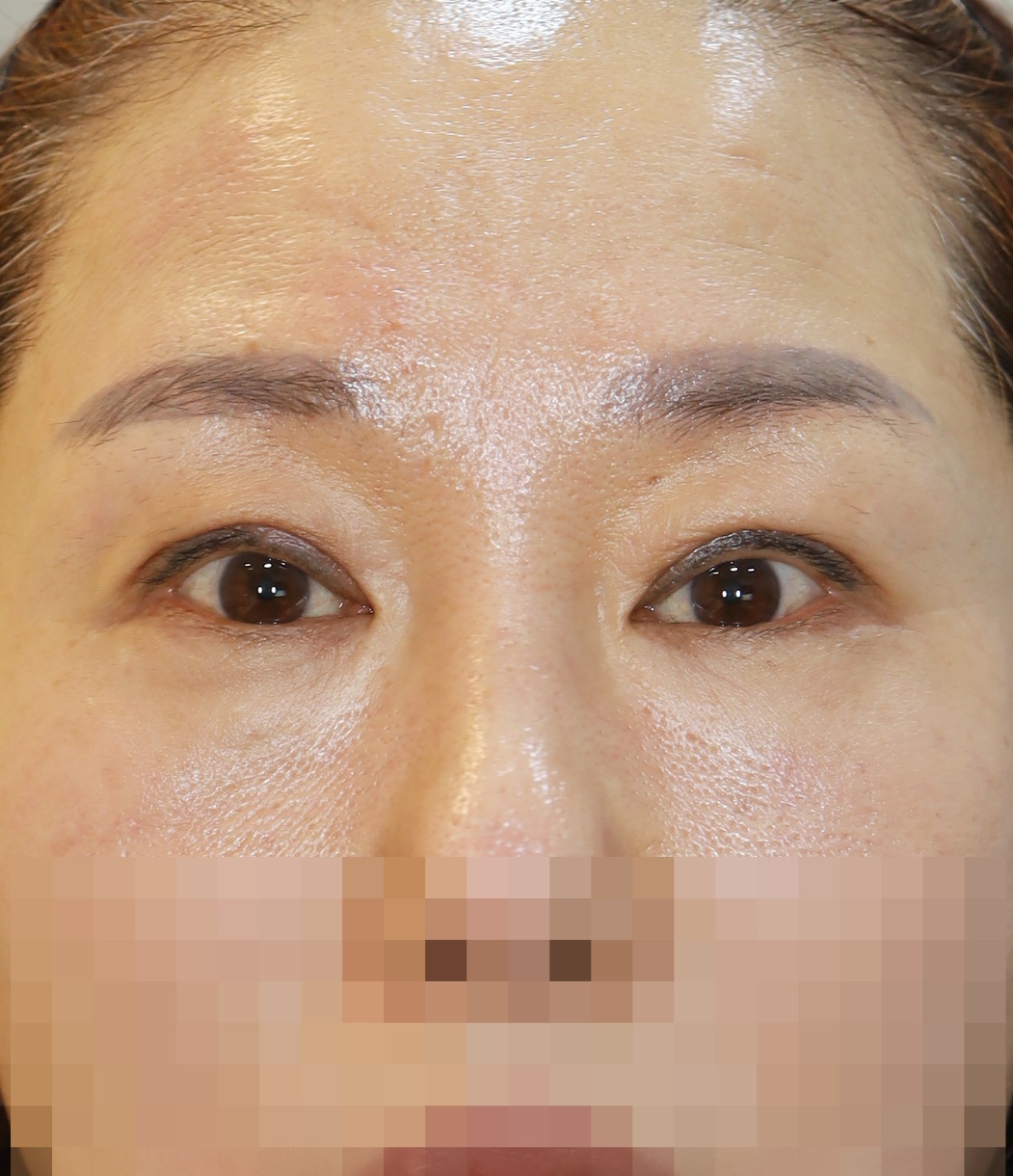 쌍꺼풀 라인 낮추기; 두줄따기, 눈위 지방 재배치 3개월 수술후
