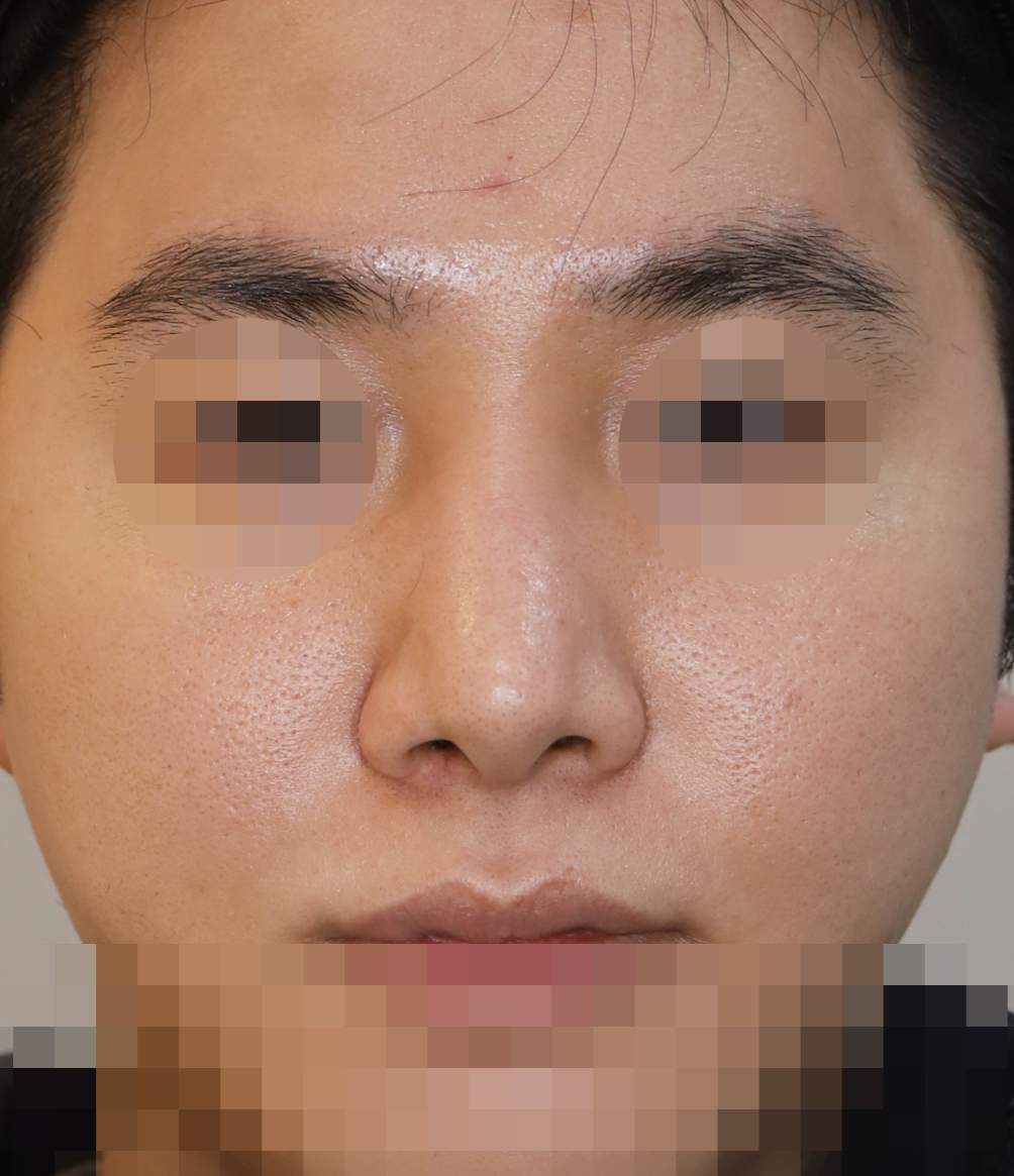 무보형물 코성형; 비주내리기, 콧볼축소 수술후