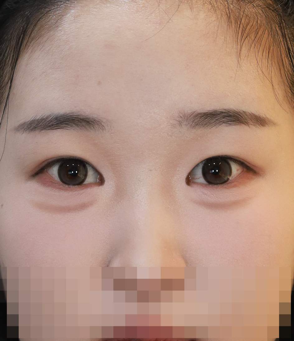 절개 쌍꺼풀, 앞 위 트임 수술후