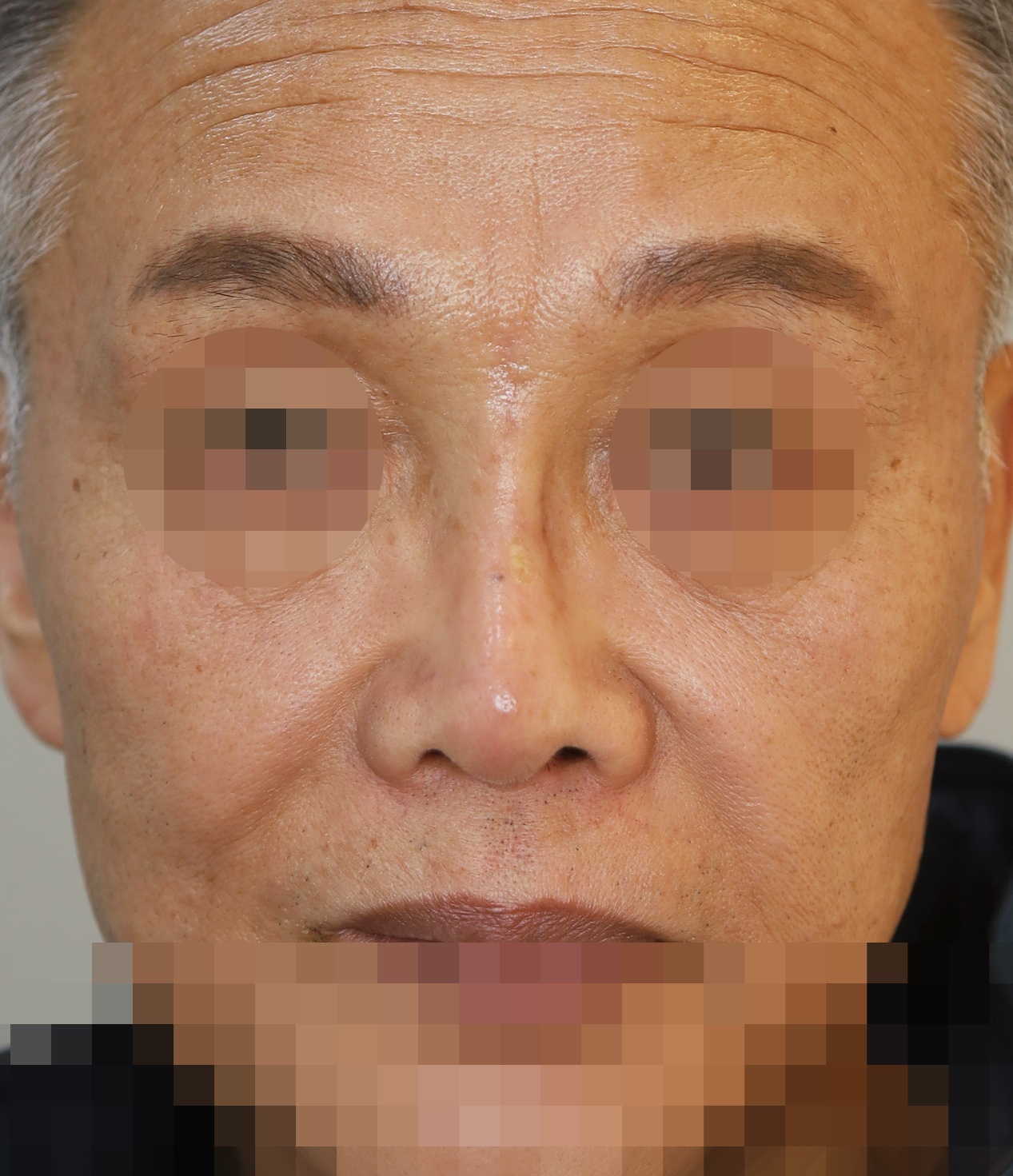 보형물 제거, 흉터성형, 구축코 교정, 코끝 복원 6개월 수술후