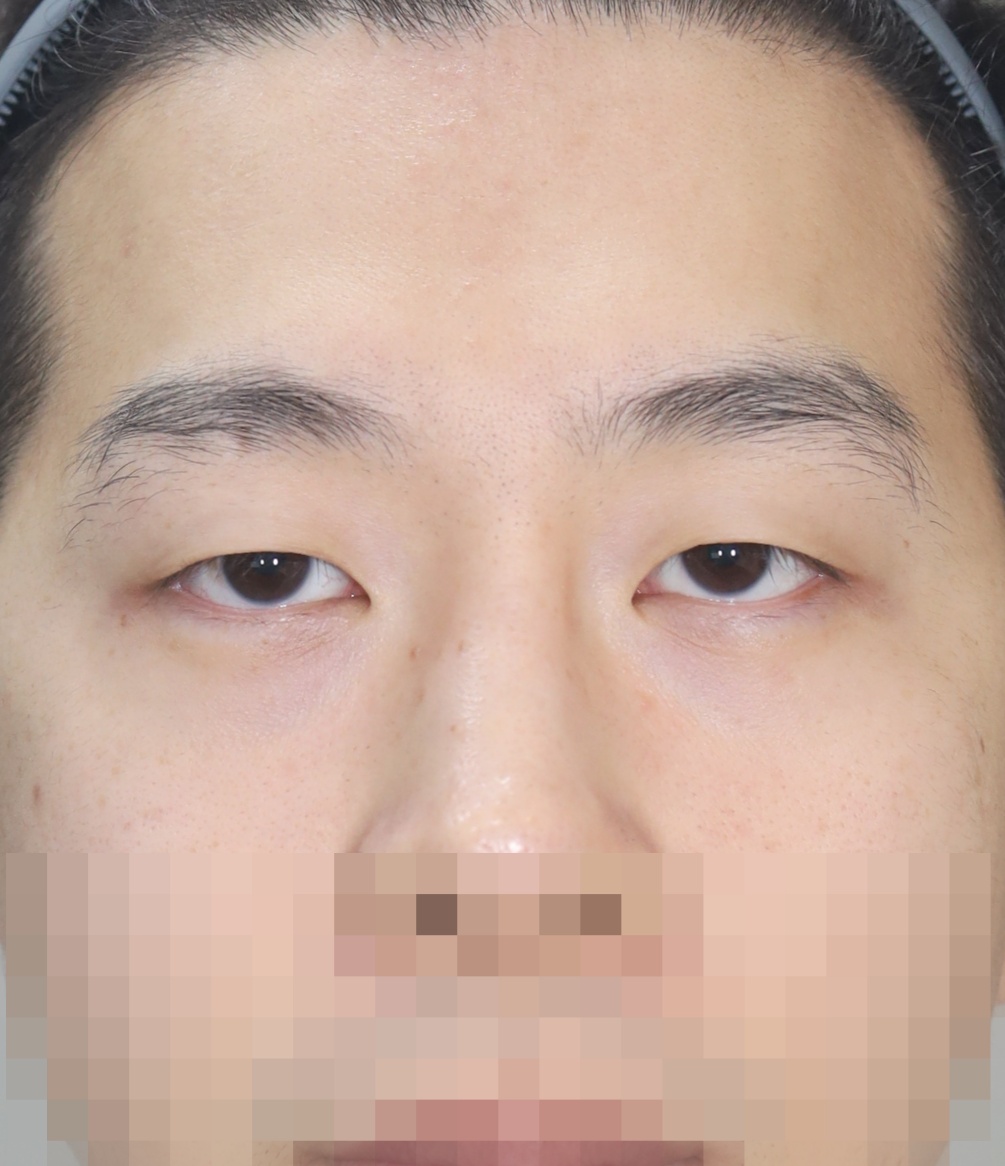 비절개 쌍꺼풀 2년 수술전