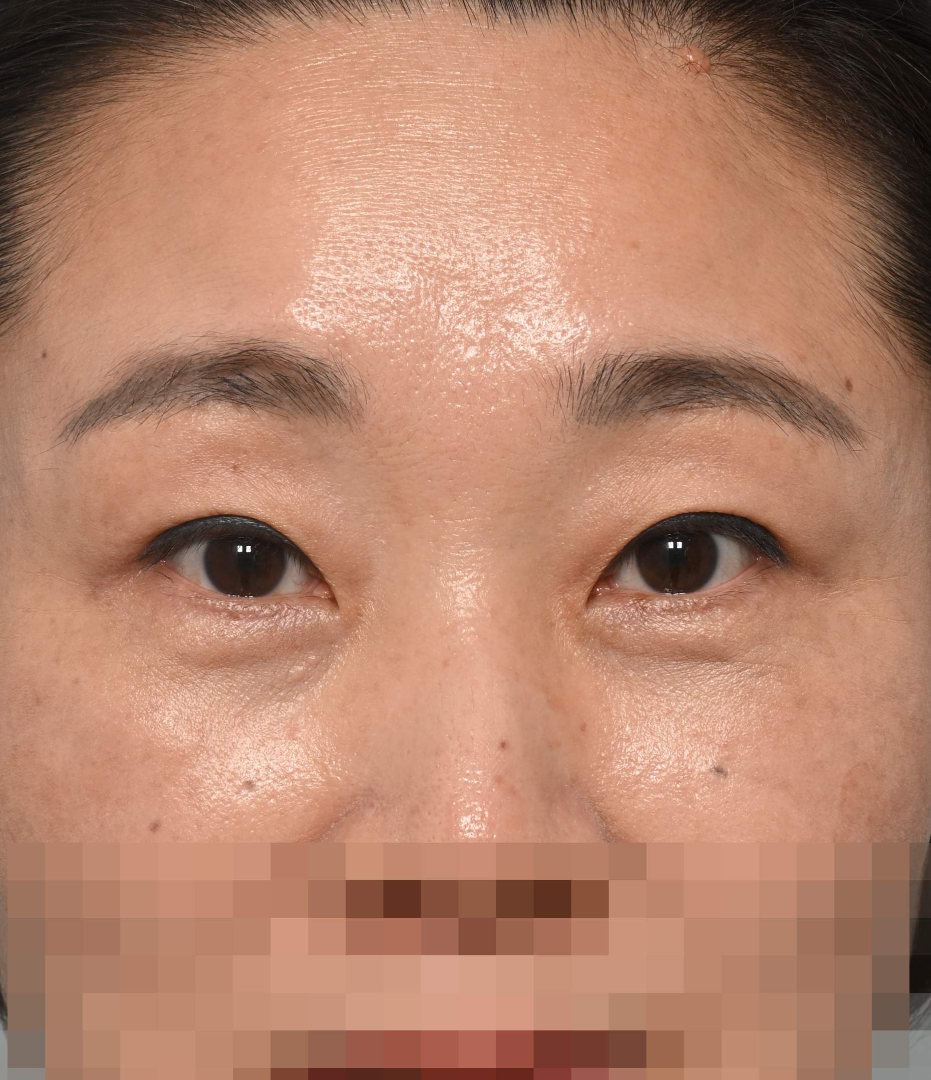 절개 쌍꺼풀, 눈썹 하 거상, 눈밑 지방 재배치 2년 수술후