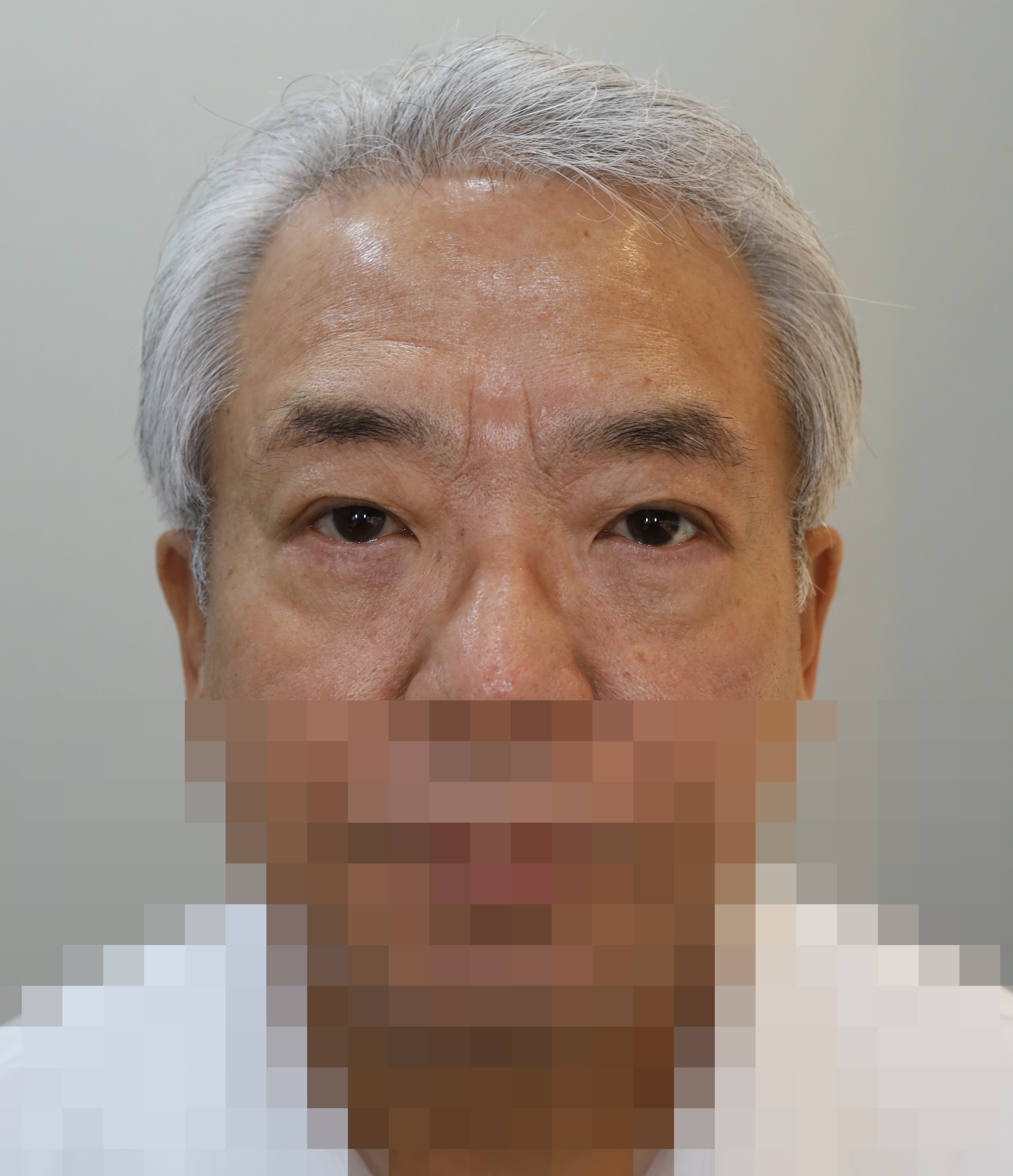 이마 거상 축소, 눈썹 밑 거상, 하안검 5개월 수술후
