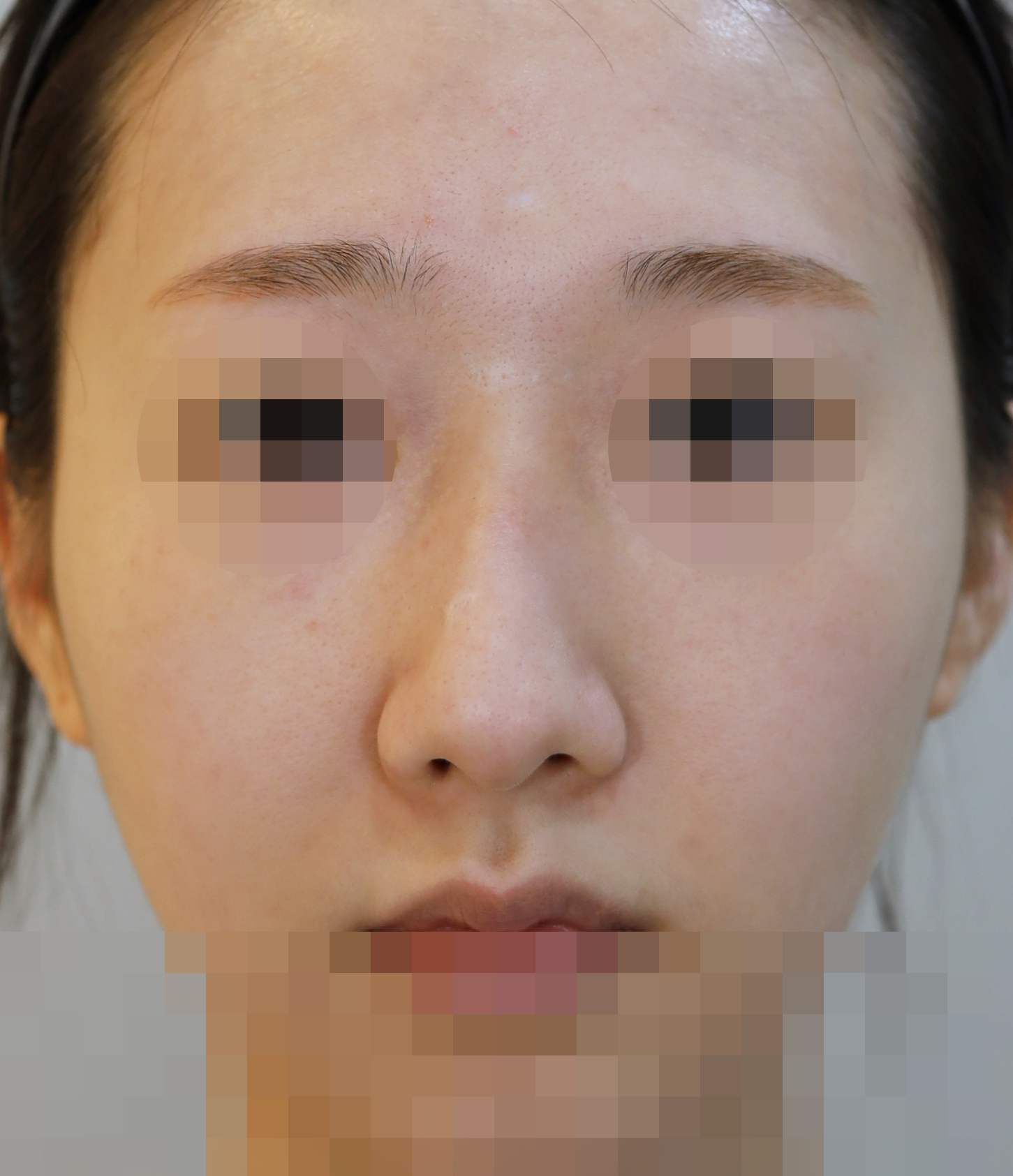 무보형물 코성형; 휜코 교정, 매부리 교정 수술전