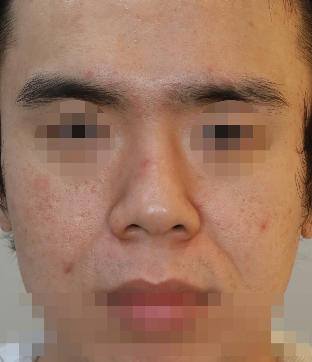 무보형물 코성형; 비주내리기, 짧은코 교정 5개월 수술전