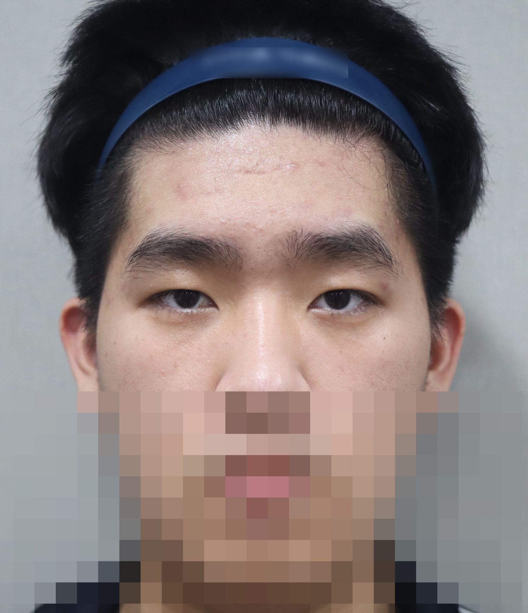 이마 거상, 비절개 눈매교정 4개월 수술후