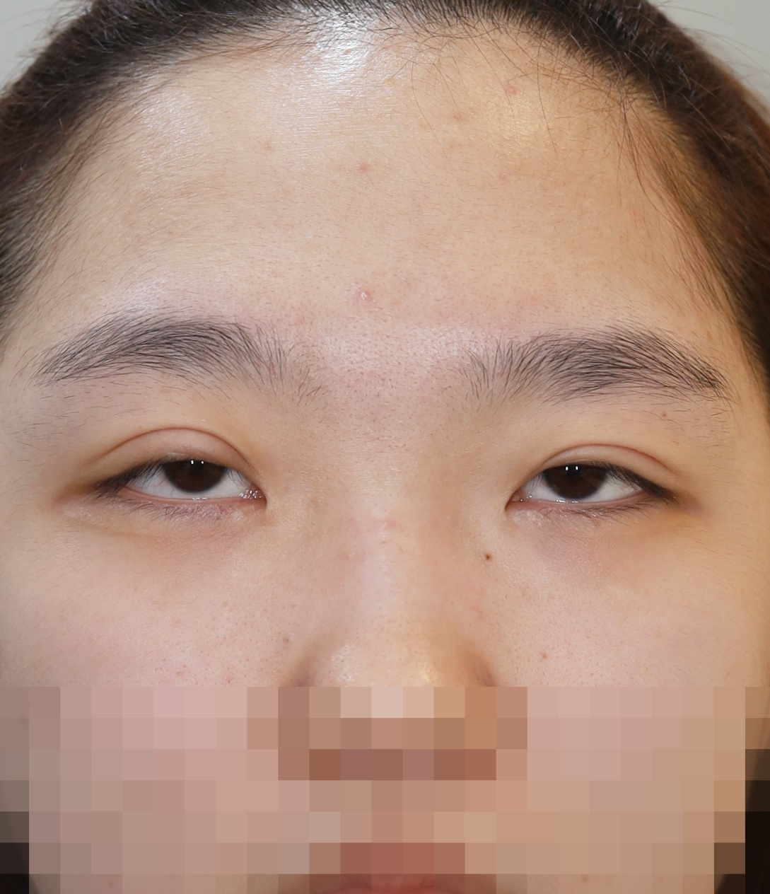 쌍꺼풀 라인 낮추기; 두줄따기, 안검하수 교정, 앞트임 6개월 수술전