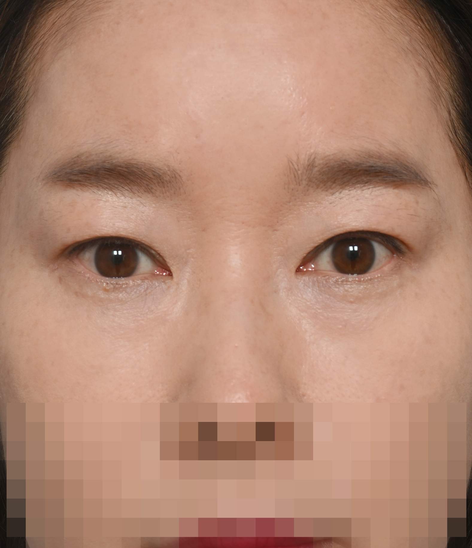 쌍꺼풀 라인 낮추기, 안검하수 교정 수술후