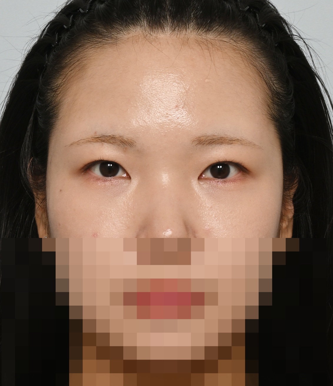 쌍꺼풀 라인 낮추기; 두줄따기 수술후