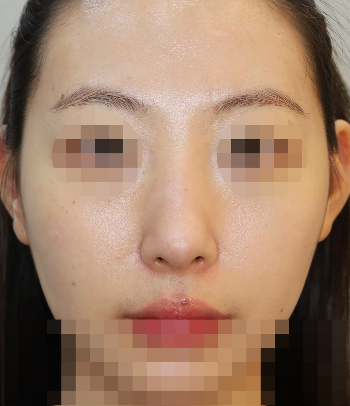 과교정 매부리 복원, 코끝 복원 3개월 수술후