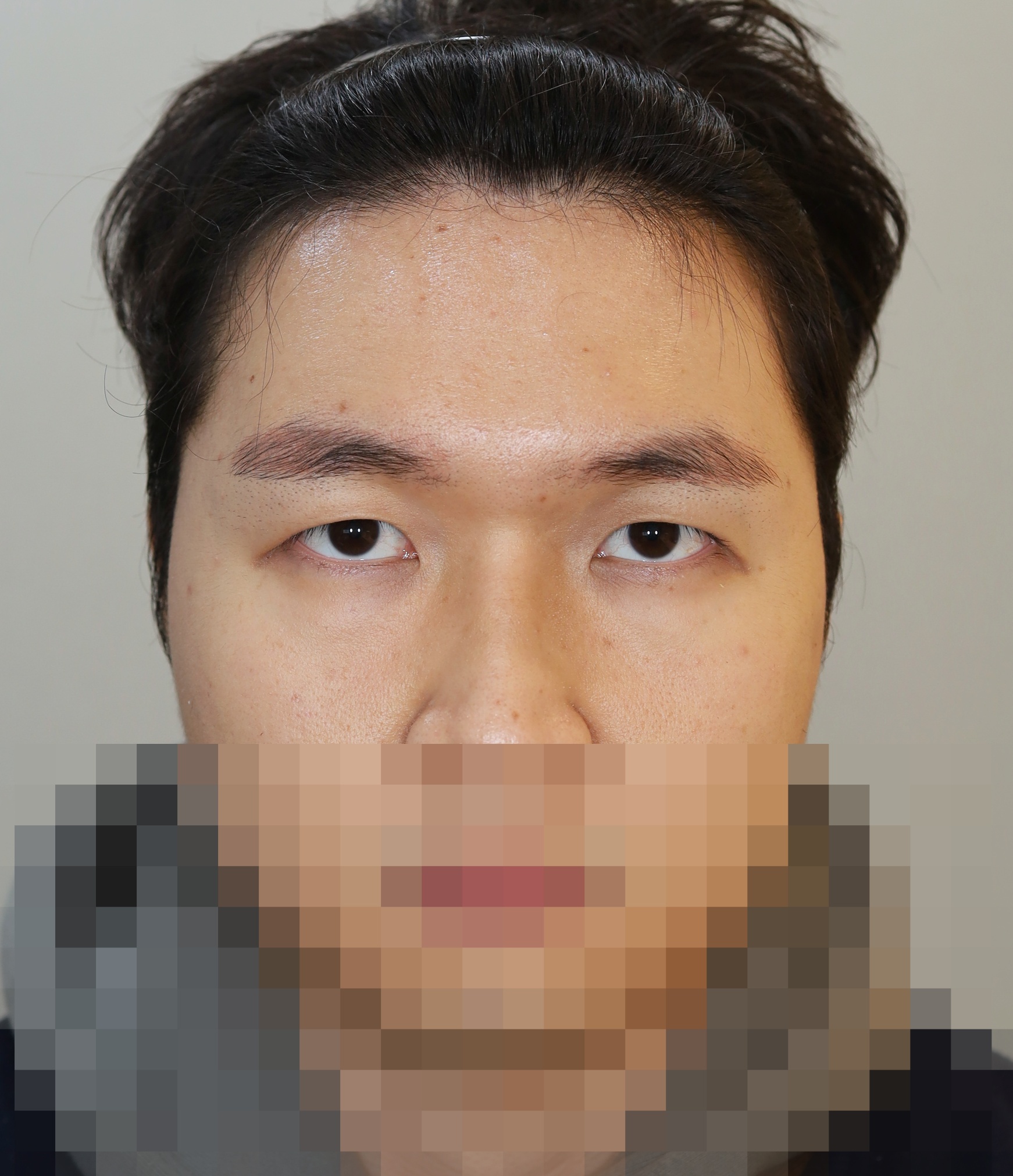 이마거상, 절개쌍꺼풀 3개월 수술후