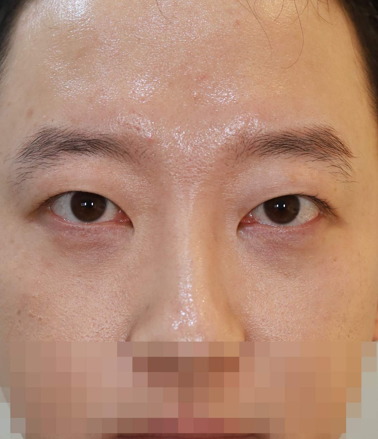 쌍꺼풀 라인 낮추기; 피부 절제법 7개월 수술후
