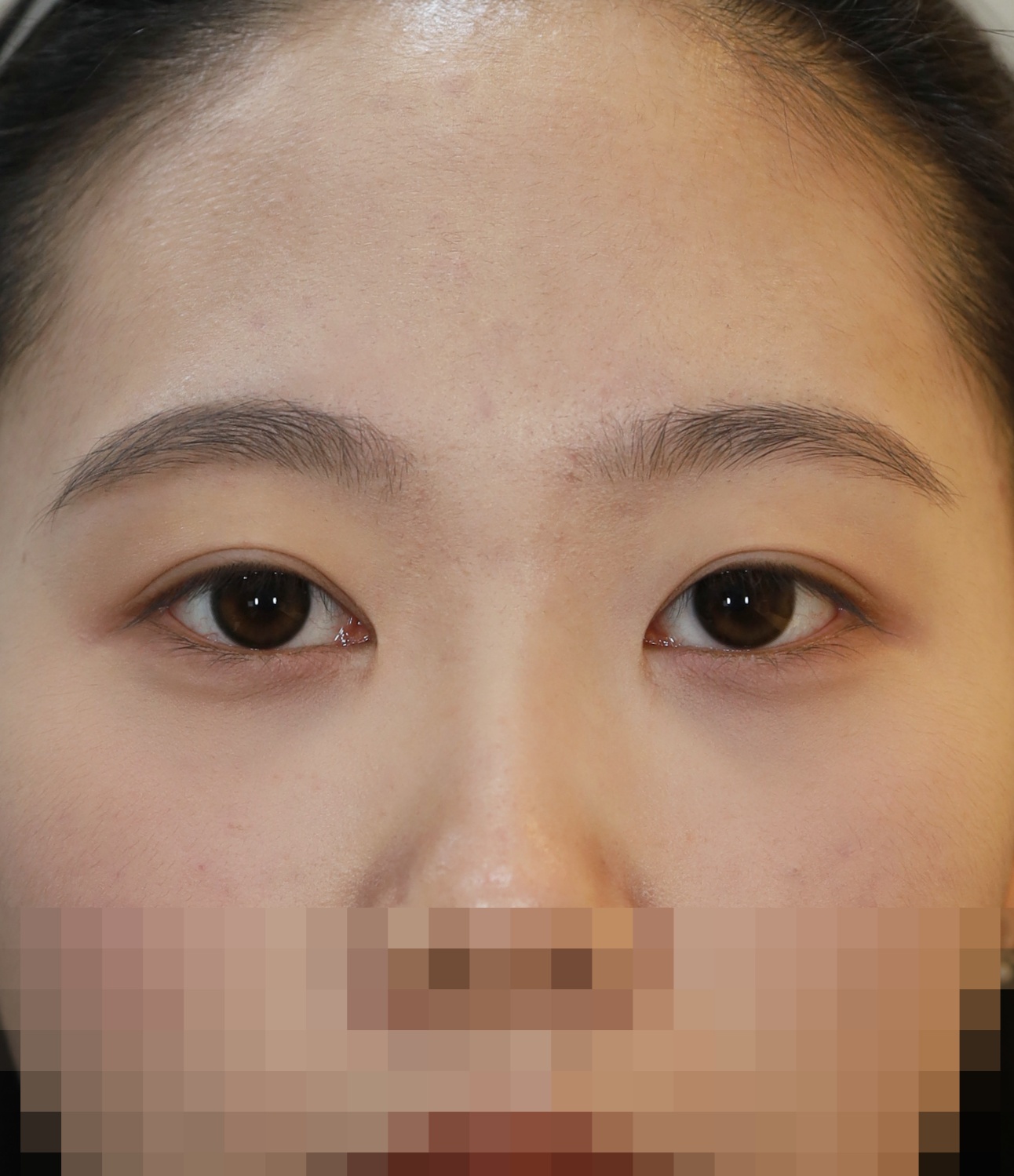 비절개 쌍꺼풀, 위트임 2년 10개월 수술후