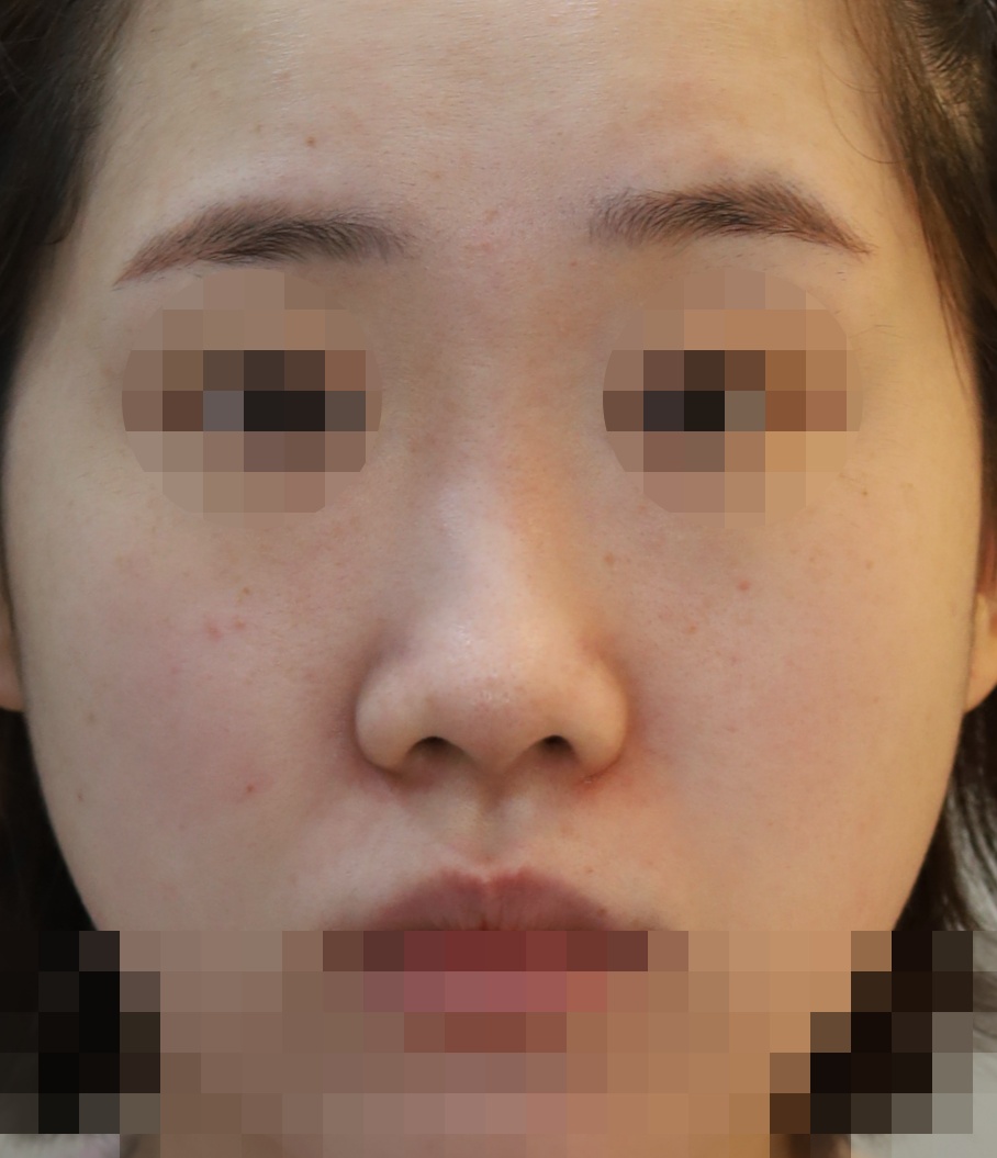 콧대(일반보형물), 코끝(비중격연골), 비순각 교정 수술전