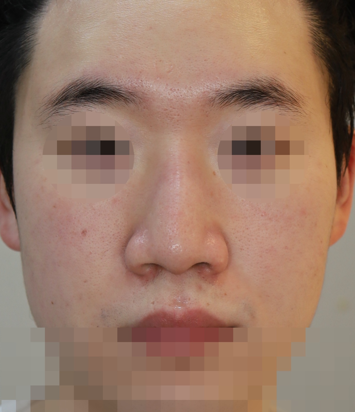 반영구 필러 제거, 무보형물 코성형; 매부리 교정 4개월 수술전