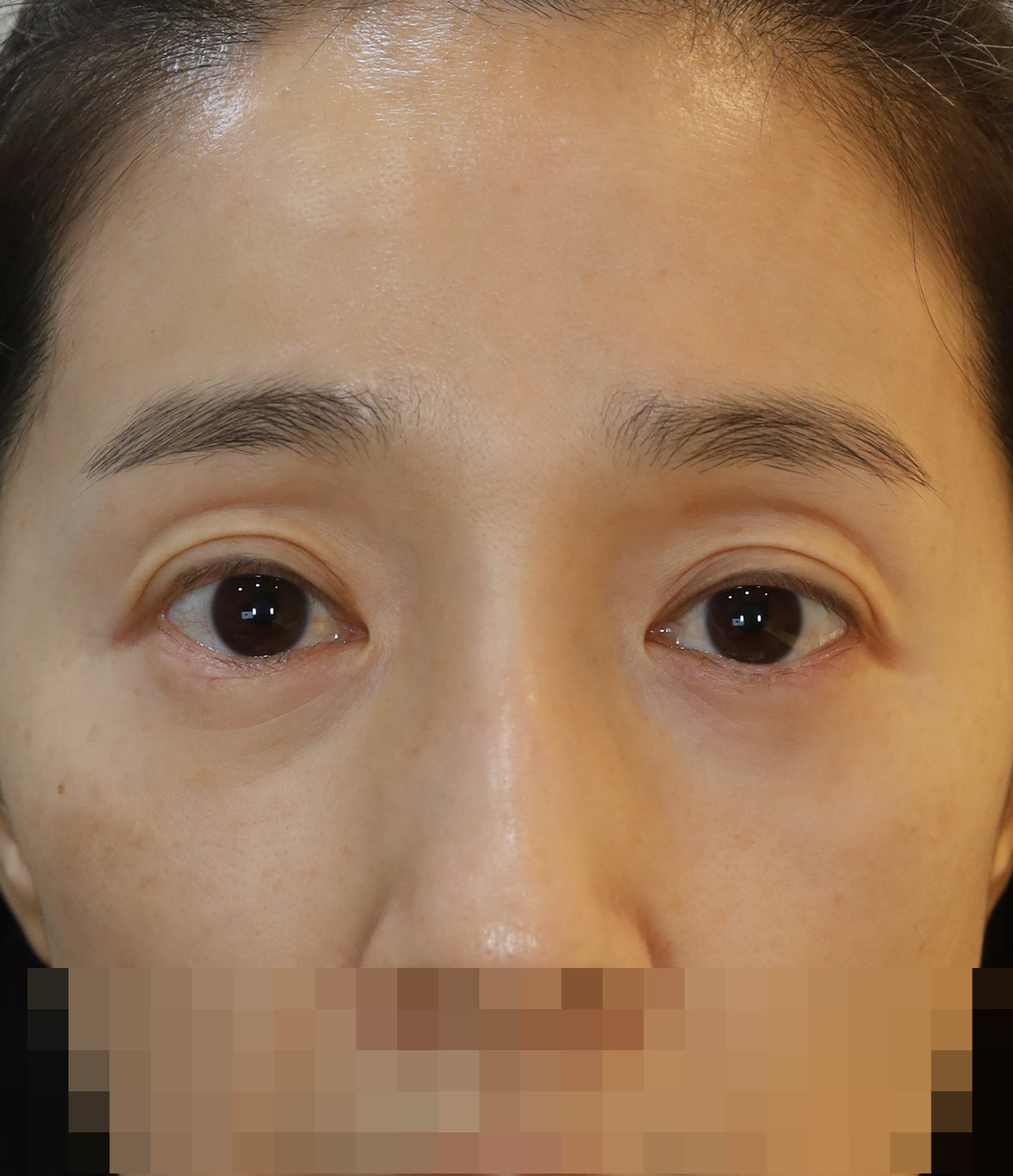 두줄따기, 눈두덩이 지방이식 5개월 수술전