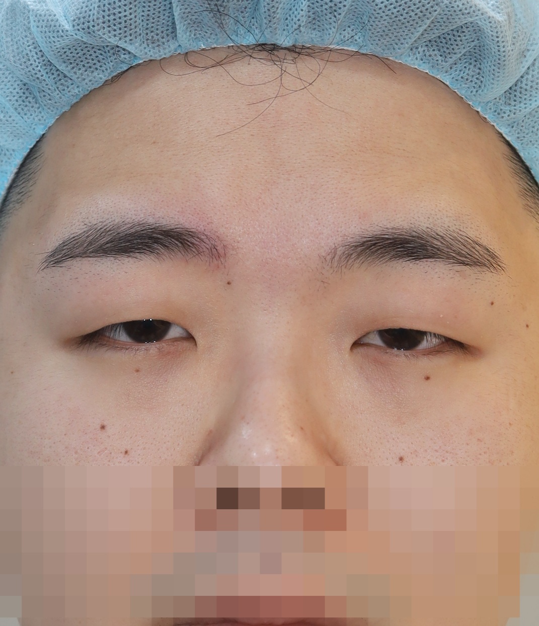 절개 쌍꺼풀, 앞위트임 3개월 수술전
