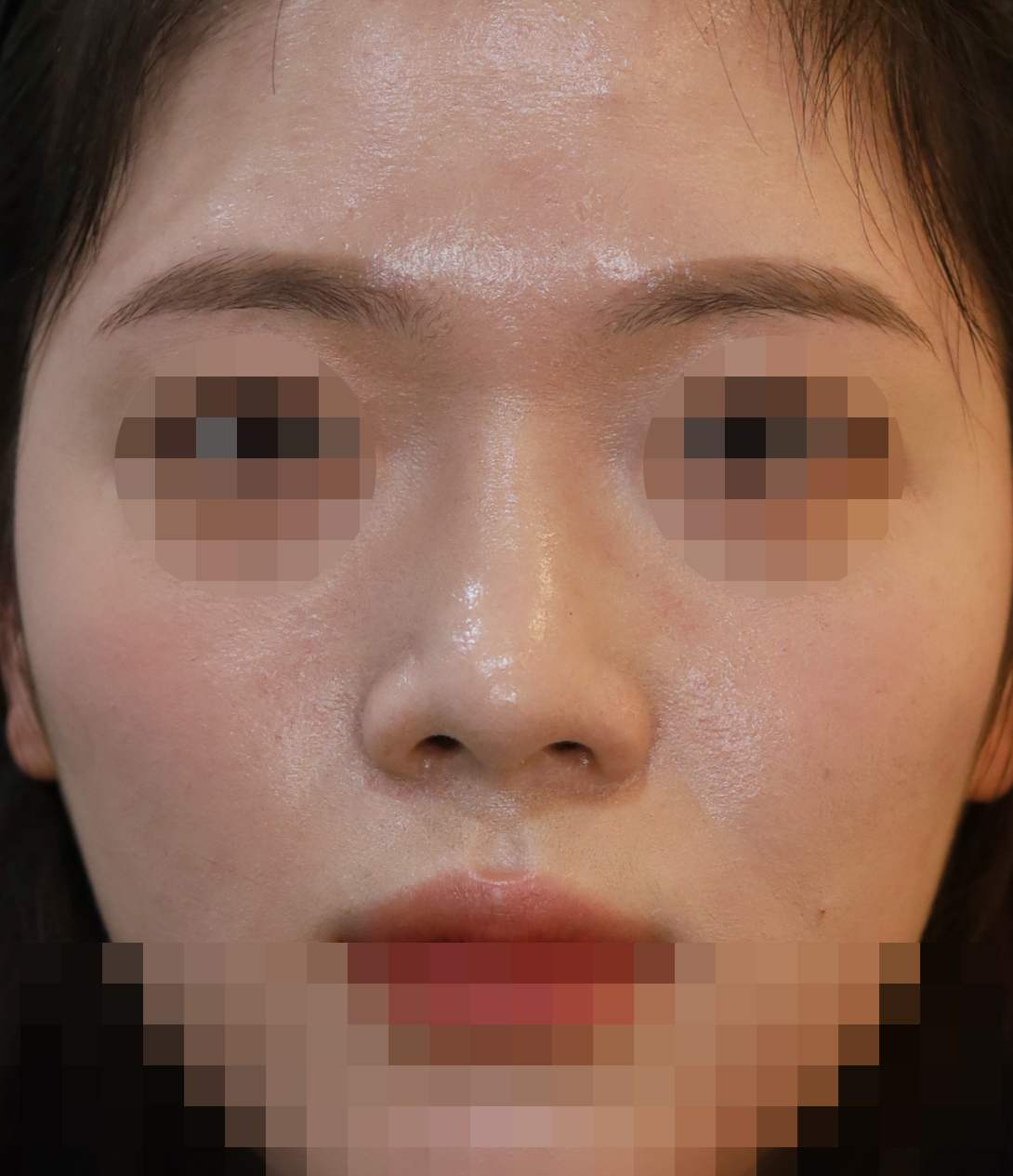 무보형물 코성형; 비주내리기 수술후